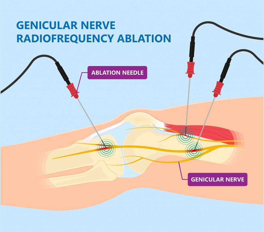 Genicular Nerve Block Spine Sports Interventional Pain Medicine