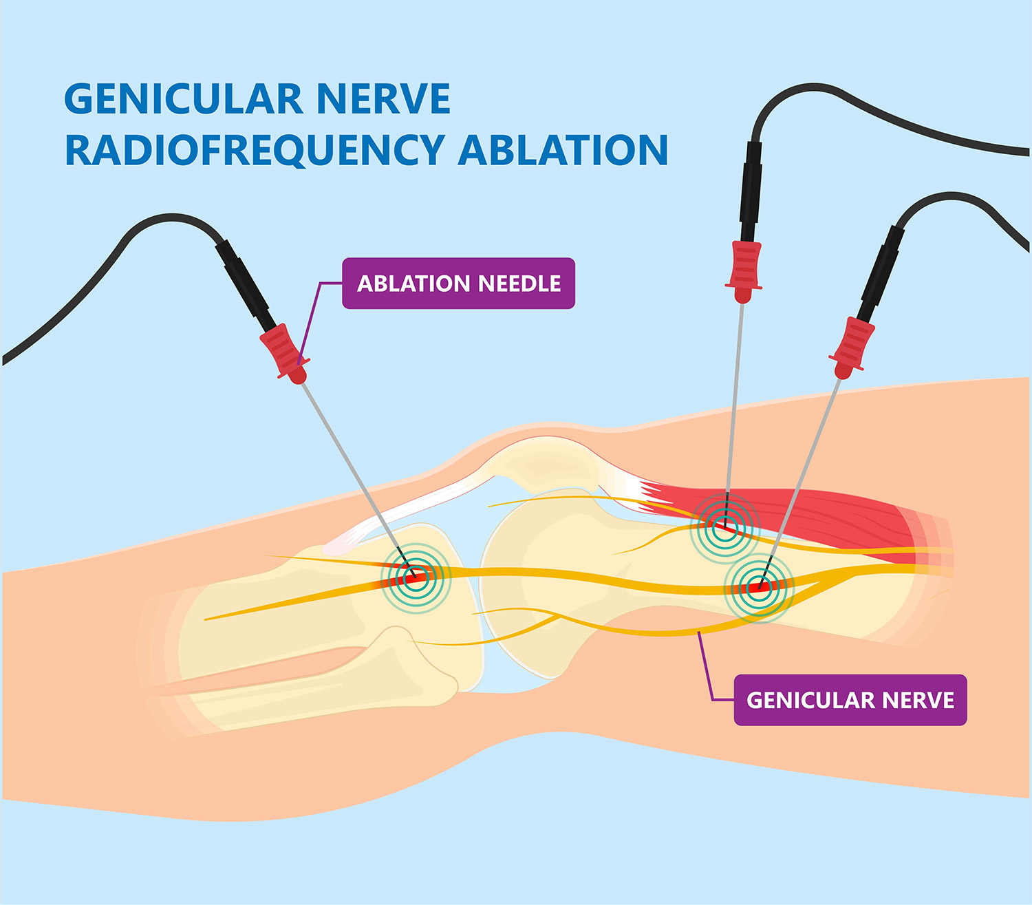 Genicular Nerve Block